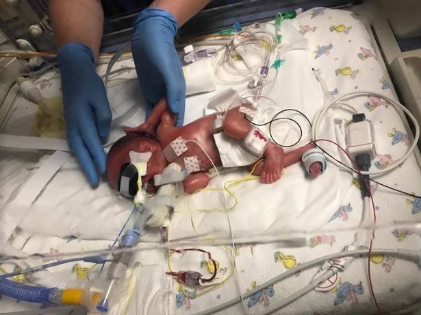 26周的早产儿只有1.1斤,本以为活不了却