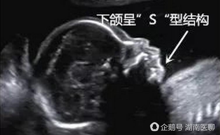 长沙一女子怀孕22周 产检被查出