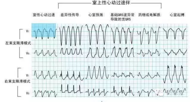 请牢记这些致命的心电图