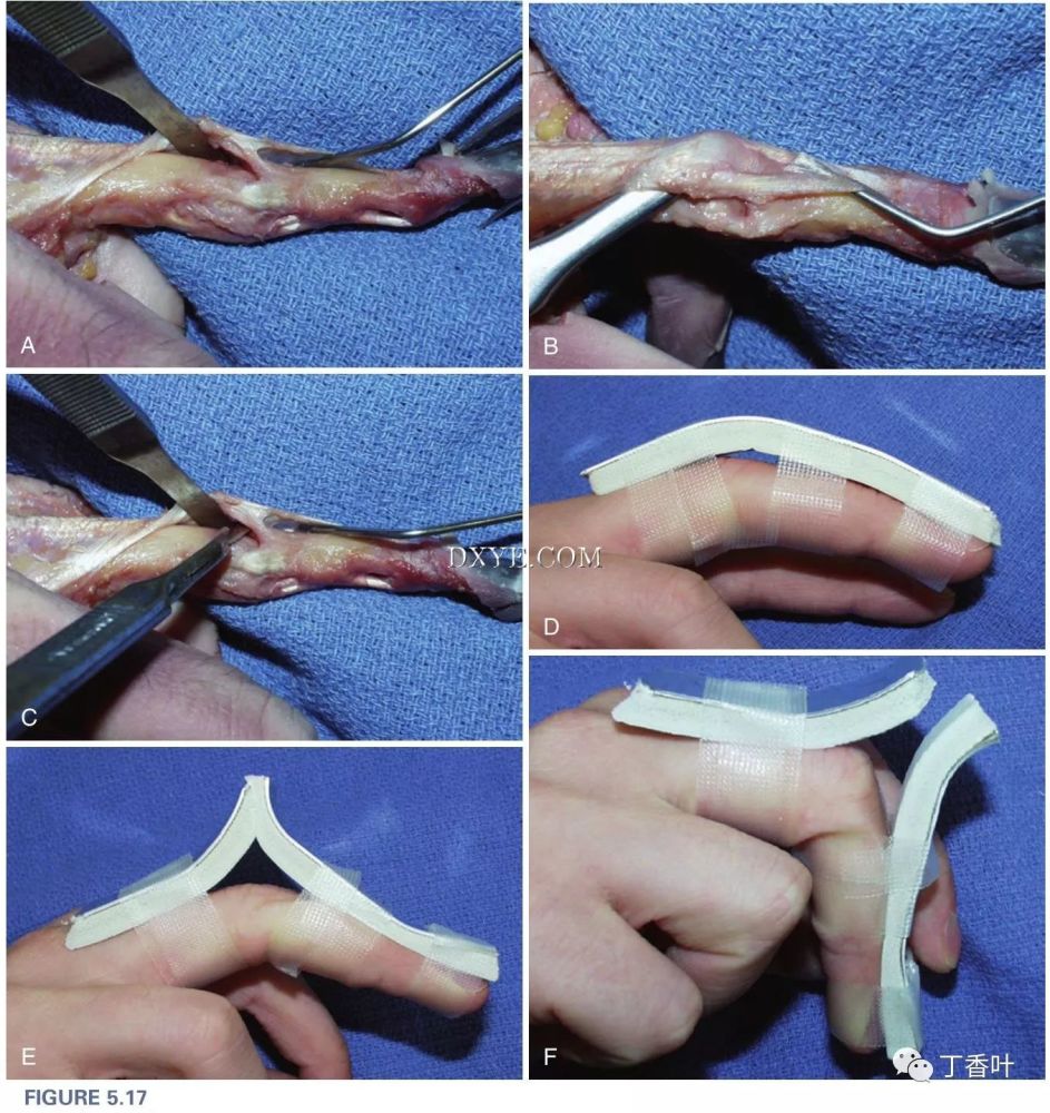 手外科的手术操作解读:60-5 伸指肌腱损伤「图解」