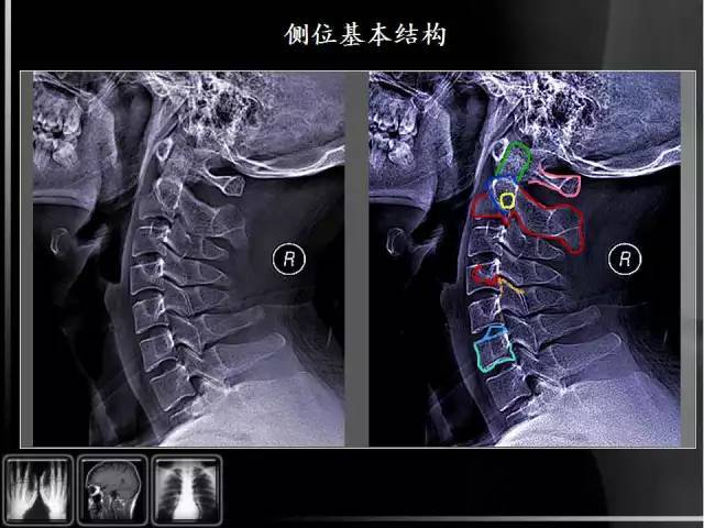 x线入门详细的颈椎x线解剖解读图文标注版
