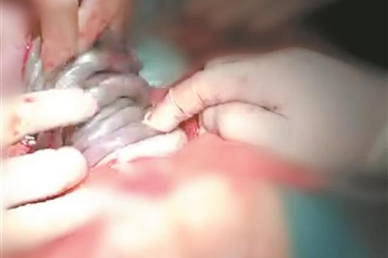 汕頭一胎兒臍帶繞頸整整7圈 護(hù)士長20年首次見到