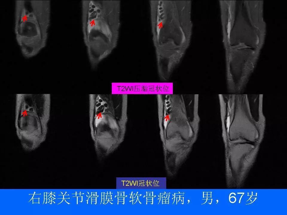 过目不忘丨滑膜骨软骨瘤病