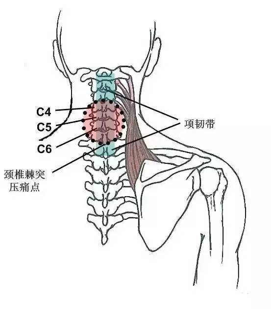 颈椎棘突压痛多见于棘上韧带亦称项韧带,压痛常见于颈椎3,4,5,6的棘