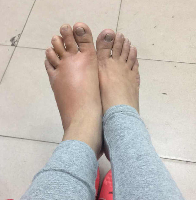 广州女子起床穿袜子 突然刺痛后左脚肿成右脚2倍胖