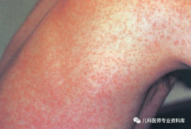 皮疹多表现为针尖大小,红色斑疹或丘疹,多在3天左右消失.