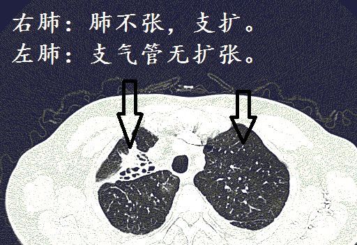 经典图谱,详细解说支气管扩张ct小诀窍!学不会我拜你为师!