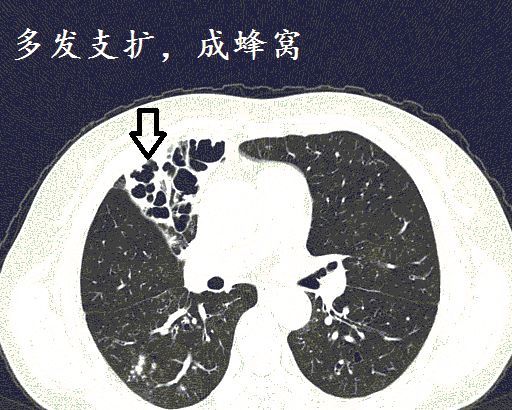 经典图谱,详细解说支气管扩张ct小诀窍!学不会我拜你为师!