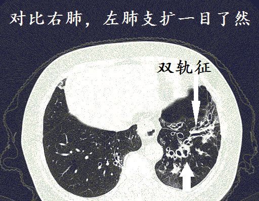 经典图谱,详细解说支气管扩张ct小诀窍!学不会我拜你为师!