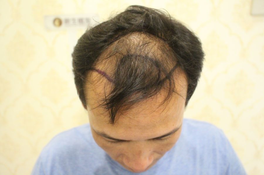 一张照片判断你的脱发类型,都来试试看
