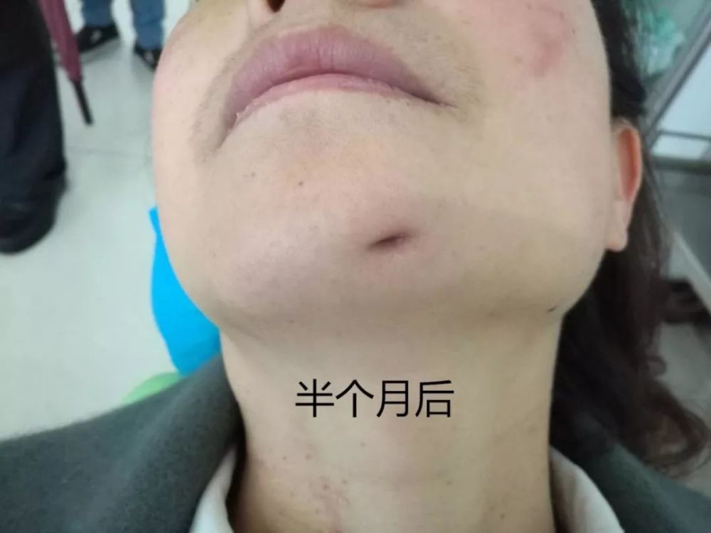 半个月后瘘口开始收缩,再也没有出现过流脓渗出现象,于是信心大增