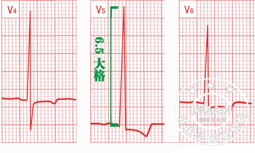 左心室肥厚,那电轴自然向左偏咯13,预激综合征我们这里讲一个典型的