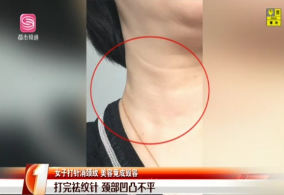 南山女子打祛紋針頸部變得凹凸不平 懷疑自己得絕癥