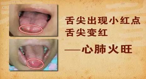 中医教你从舌头辨识出哪里上火