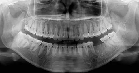补牙,做根管治疗(牙痛),牙周病,种植牙,牙齿矫正等都需要进行拍片