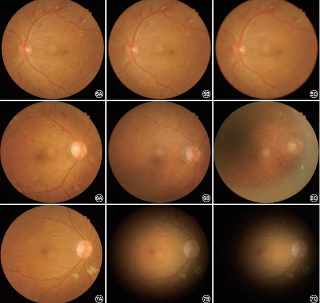 我国糖尿病视网膜病变筛查的图像采集及阅片指南2017年
