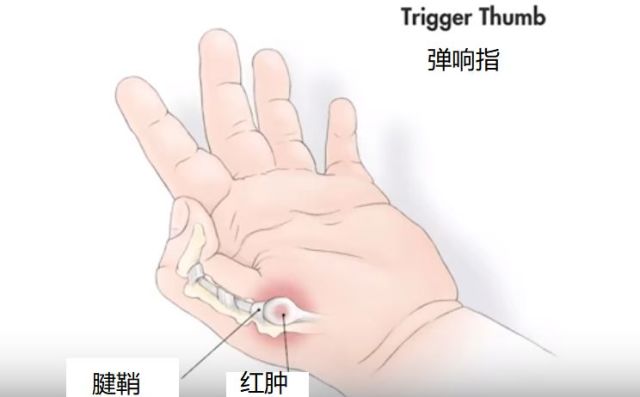 宝宝手指伸不直是怎么回事?得了腱鞘炎一定要手术吗?