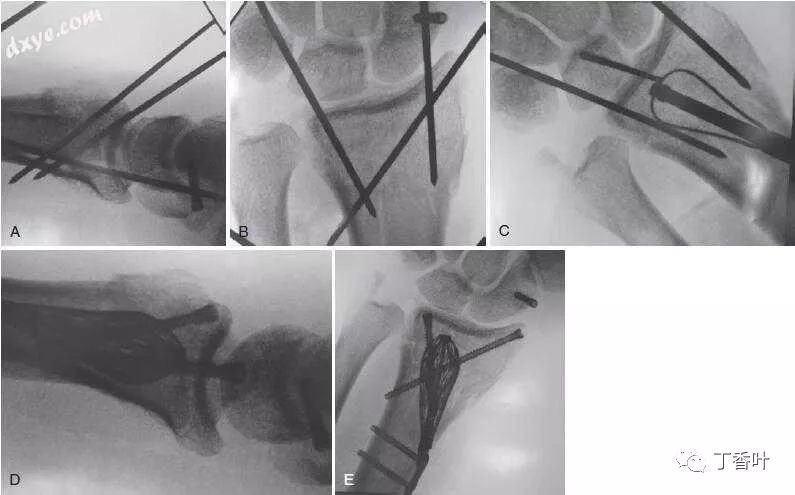 手外科的手术操作解读:60-15 桡骨远端骨折「图解」
