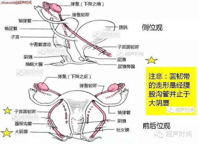 典型超声病例:子宫圆韧带静脉曲张