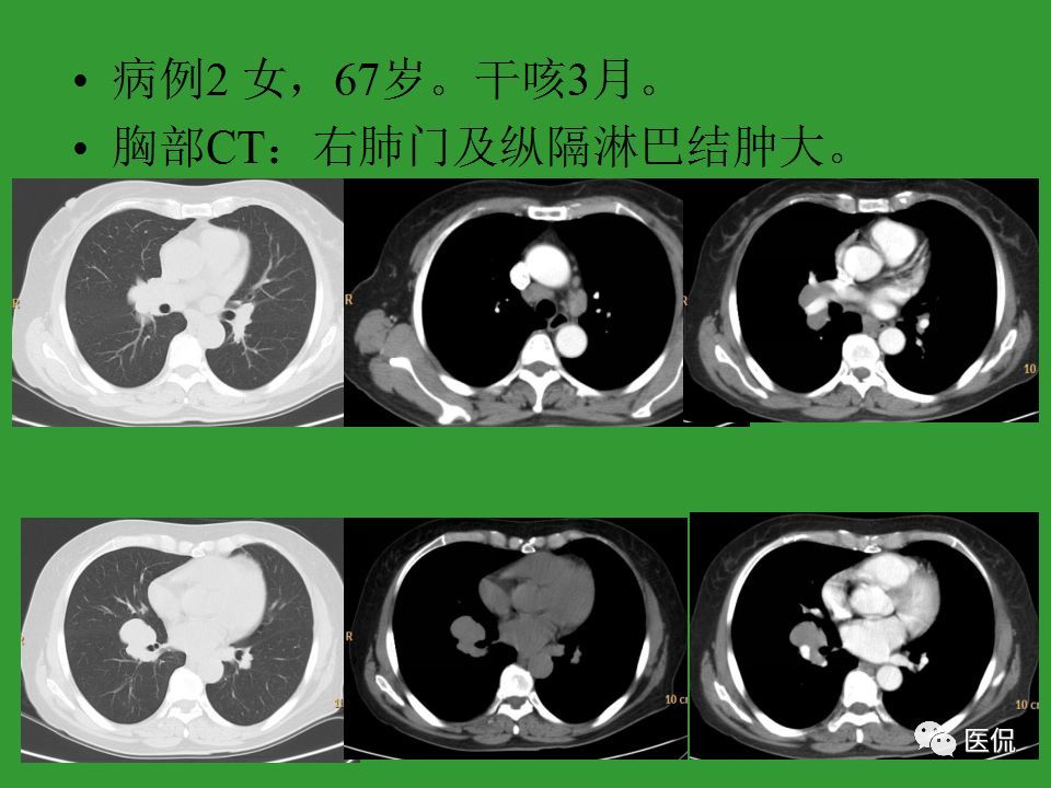 30个病例一次搞懂:纵隔淋巴结肿大的诊断和鉴别诊断