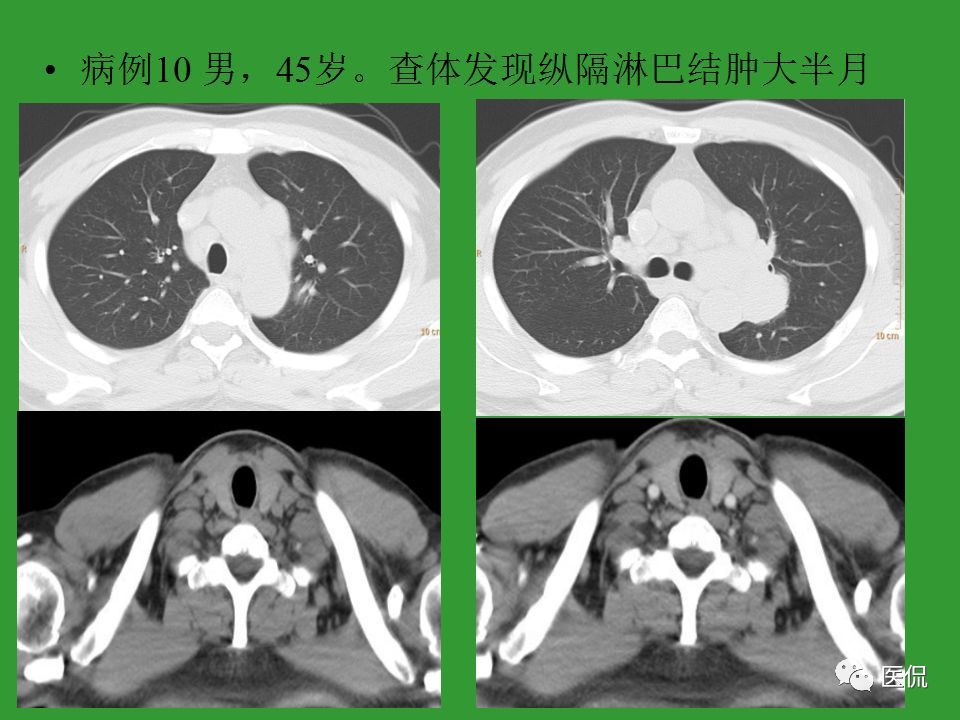 30个病例一次搞懂:纵隔淋巴结肿大的诊断和鉴别诊断