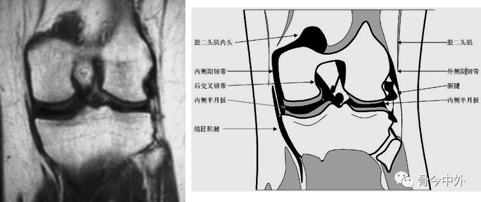 膝关节半月板及韧带的mri诊断