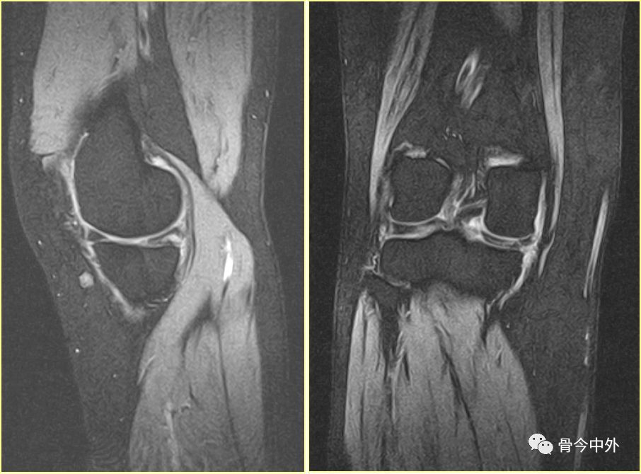 膝关节半月板及韧带的mri诊断