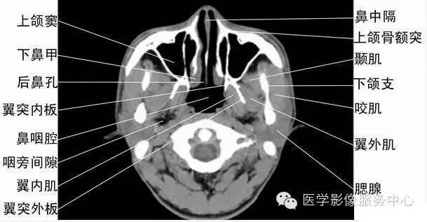 压迫因素;影像学表现鼻中隔偏曲ct表现为鼻中隔偏离中线或局部突起,常