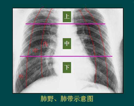 纵隔两旁含气的肺在胸片上所显示的透明区域称肺野,其透明度随呼吸而