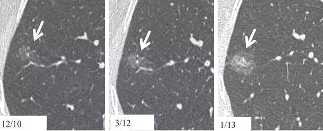 14 种教科书级"肺结节"长啥样?