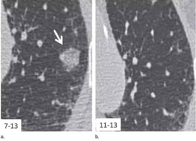 14 种教科书级"肺结节"长啥样?