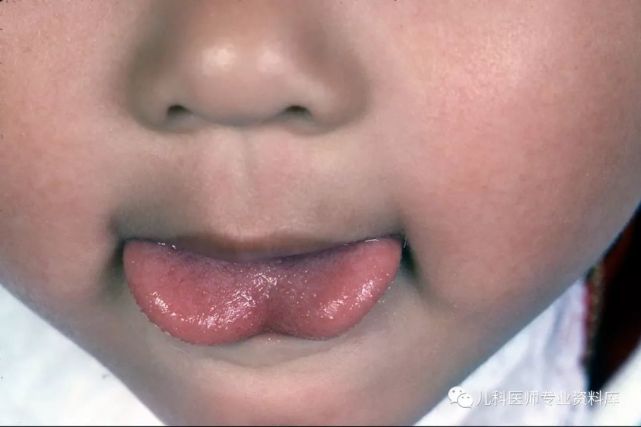 娃研所丨宝宝舌系带过短影响吃奶,发言不清楚,舌头