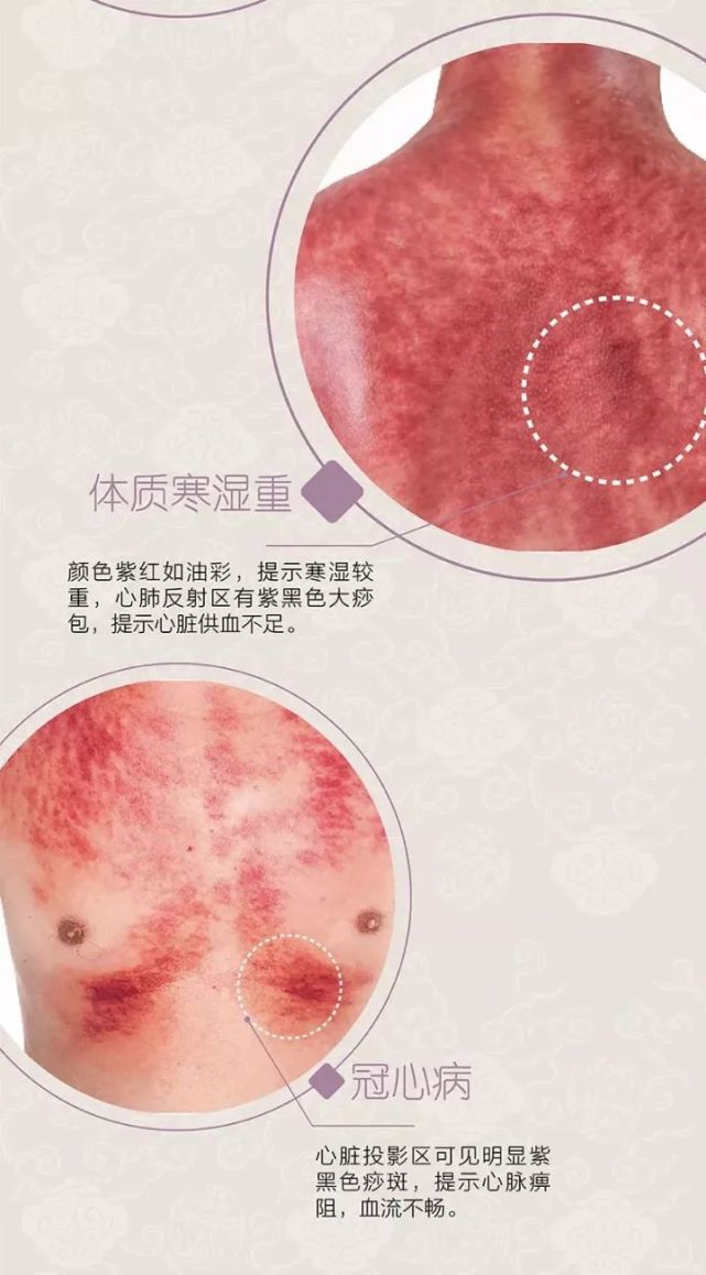 刮痧刮多了,身体就虚了吗?刮痧自诊,健康状况早知道!