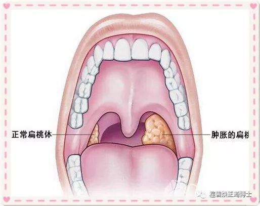 注意在腺样体肥大处,气流难以通过,这样将导致患者张口呼吸.