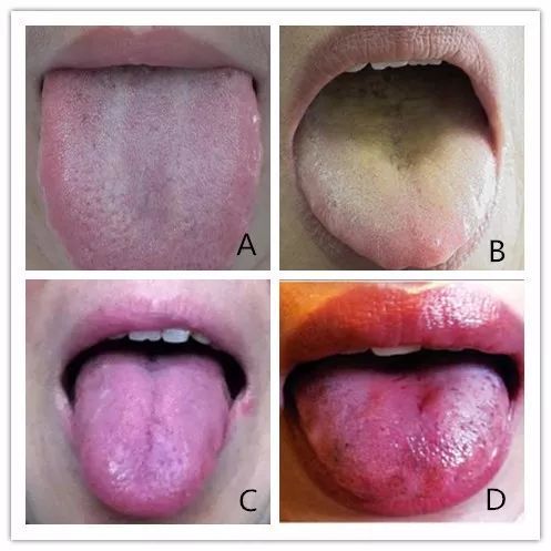 舌头是疾病的照妖镜中医教你5招通过舌诊看出疾病