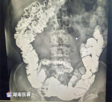郴州一男子35天未排便 手术取出一大盆粪石6斤