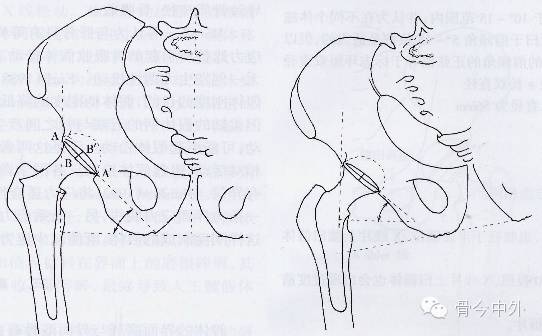 翻修后 9,髋关节舲换术后正常的x线片 髋臼外展角 髋臼前倾角