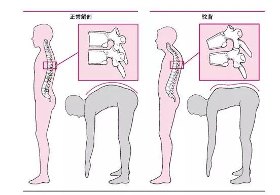 如果驼背的话,你会发现头是向前倾的,而且会驼出"小肚腩",显得没气质