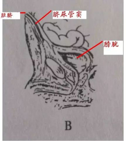 上面这张图片就完整的显示了脐尿管瘘,我们可以看到宝宝肚脐和膀胱