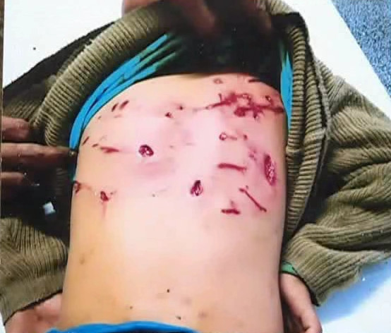 韶关7岁男童在学校内被狗咬到伤痕累累