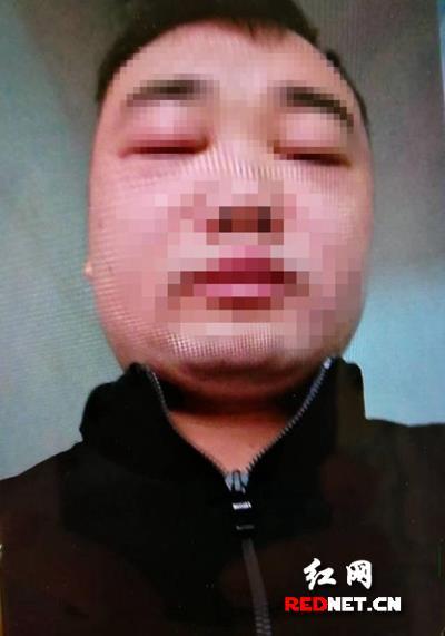 益阳一男子盲目听信老中医 错误用药眼睛肿成