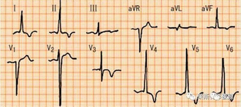 左室肥大伴劳损导致的倒置t波3t波特征性改变当心绞痛再次发作之后