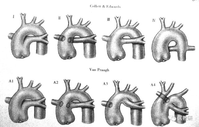 根据肺动脉起源部位的不同,永存动脉干有数种分型方法.