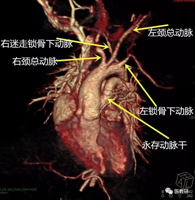 永存动脉干