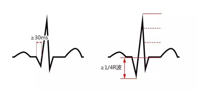 急性心梗心电图各阶段特点汇总分析