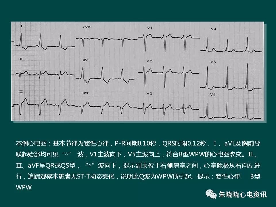 预激综合征(ppt)