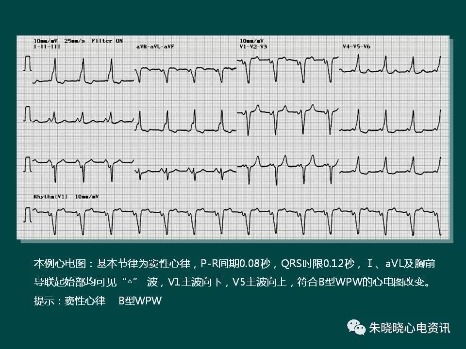 预激综合征(ppt)