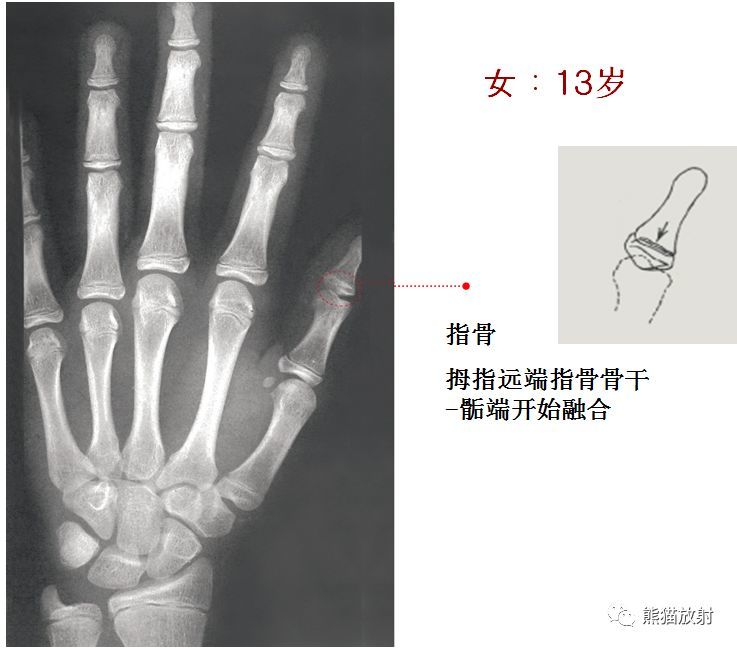 儿童生长发育骨龄图谱