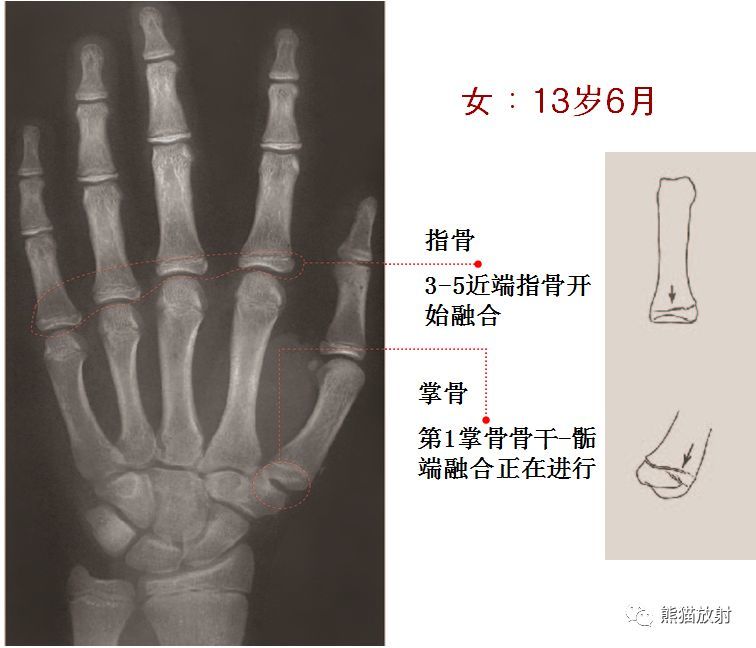 儿童生长发育骨龄图谱