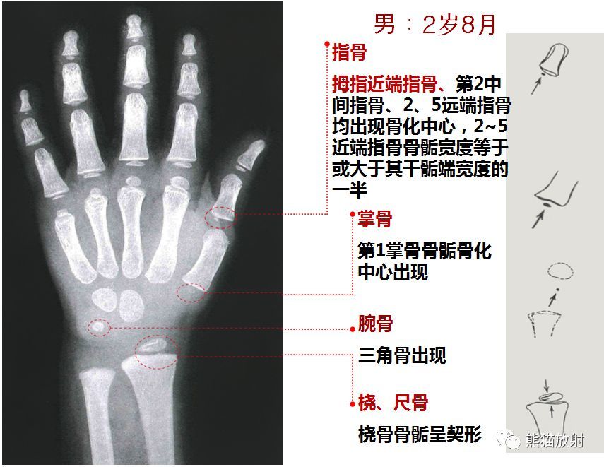 儿童生长发育骨龄图谱